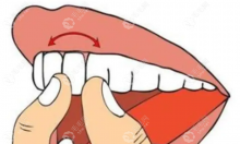 成年以后千万别整牙否则牙齿会松动?真相是牙松动后能恢复