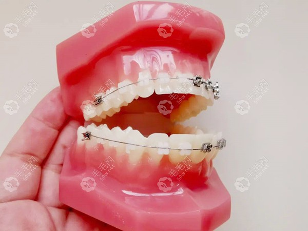 矫正龅牙技术不同价格也不同59w.net