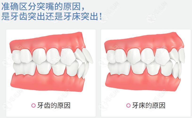 牙性和骨性龅牙示意图