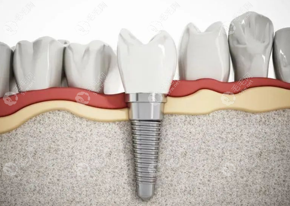 牙槽骨高度/宽度多少可以做种植牙?即刻种植牙槽骨厚度get