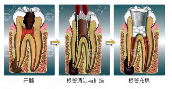 北京根管治疗一颗牙一根根管大概多少钱？300-500元左右