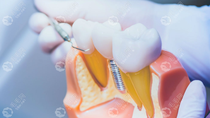 银川口腔医院收费标准新版:集采后种植牙价格3k+/牙齿矫正8k+