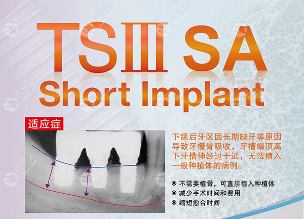 TSIII SA超短型号是垂直骨不足专用种植体