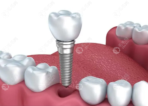 SG种植体使用纯钛材质与牙冠的结合强度更高