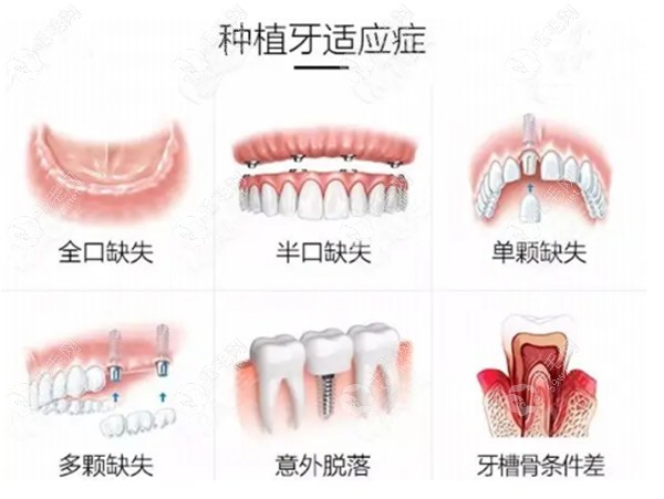 北京正规医院种植牙收费标准2023年:便宜的一颗2980+