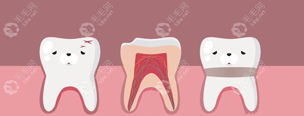 根管治疗的牙齿能用多久