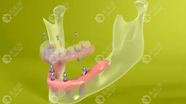 牙龈和软组织状态