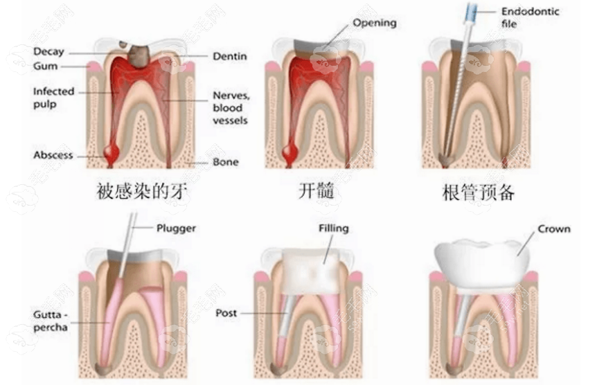 重庆根管治疗多少钱一颗牙能报吗？