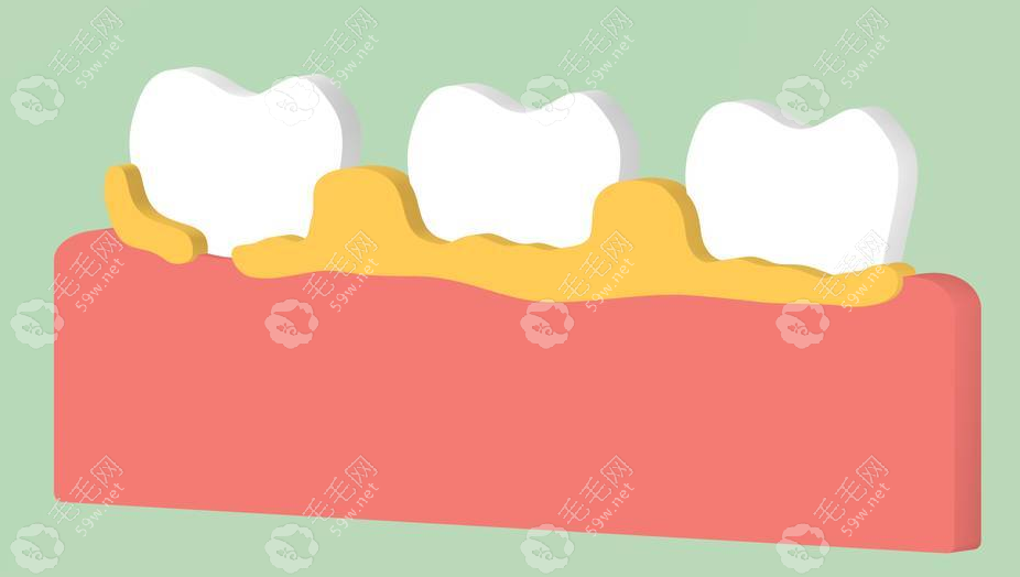 牙龈有囊肿手术一定要切除牙齿吗?小手术要切除,否则会拔牙
