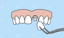 种植的牙齿和真的牙齿一样的感觉吗?它和原来的牙一样牢固