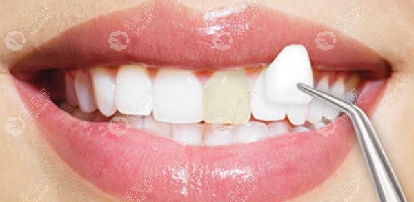 牙齿发黄怎么可以变白?牙齿黄了超简单的变白方法-做牙贴面