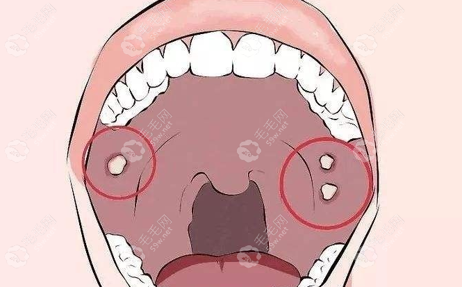 口腔黏膜纤维化有什么症状www.59w.net