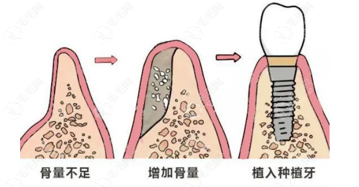 种植牙植骨需要多长时间与骨结合?3-6个月左右