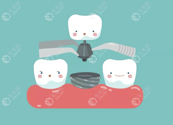 种植牙的临床使用范围比精密附着体义齿要广