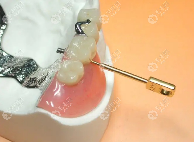 精密附着体义齿和种植牙能达到一样的美观性
