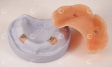 精密附着体义齿和种植牙哪种好?口腔条件好就种牙/否则义齿
