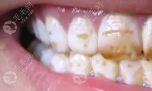 氟斑牙为什么都在门牙,去除氟斑牙除了牙贴面还有什么办法