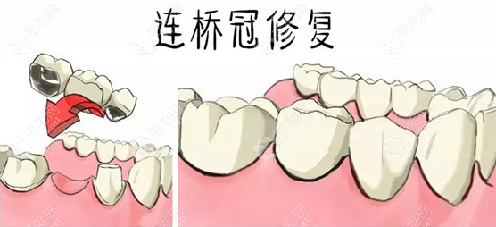 缺失一颗牙做3连桥的利弊:价格便宜,但是两边的牙会受伤害