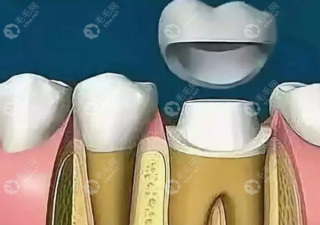 4号牙根管后需不需要做牙冠?需要