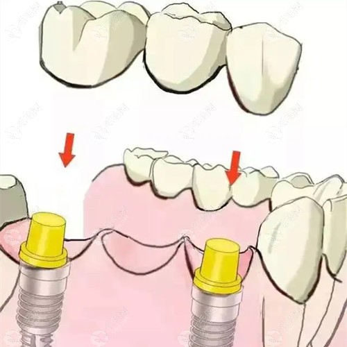 乌鲁木齐天牙口腔能做高难度种植牙手术