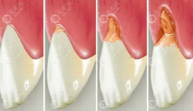 横向刷牙导致牙齿颈部缺损图片