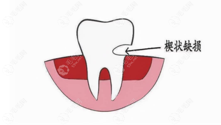牙齿楔状缺损修复