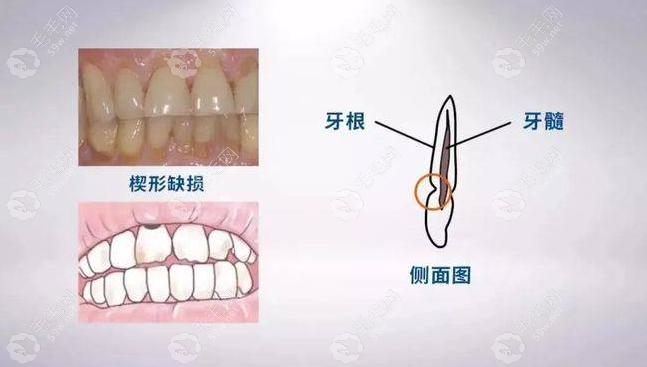 横向刷牙导致牙齿颈部缺损怎么办?无法自愈要及时修复+根管