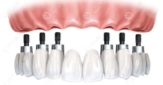 上半口种植牙四颗与六颗的区别主要是：修复方式、固定力度等