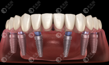 半口6颗种植牙修复过程:allon6半口种植牙需要6个月时间完成