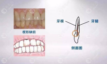 横向刷牙导致牙齿颈部缺损怎么办?无法自愈要及时修复+根管