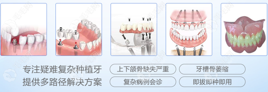 广州团圆口腔种植牙好