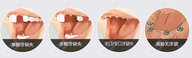 广州花都种植牙好的口腔技术好