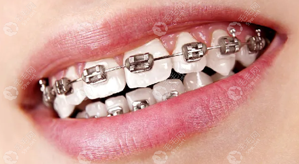 惠州口腔医院矫正牙齿价目表,惠州牙齿矫正大概要花费6500+