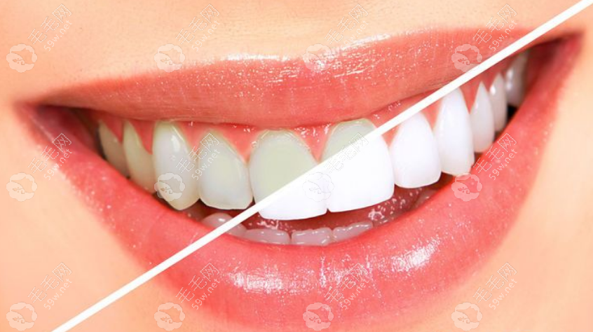 黄牙冷光美白使用不当是可能对牙齿造成伤害的