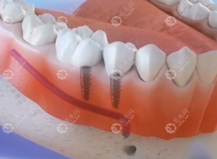 种牙填骨粉过程图解5，完成种植牙手术