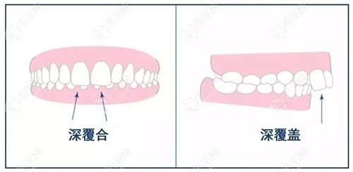 牙齿深覆合和深覆盖的区别图片:对比向前的是颌骨or上前牙