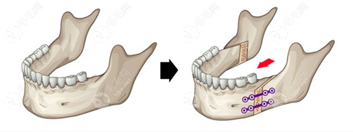 颌位重建的成效还是比不上正颌手术