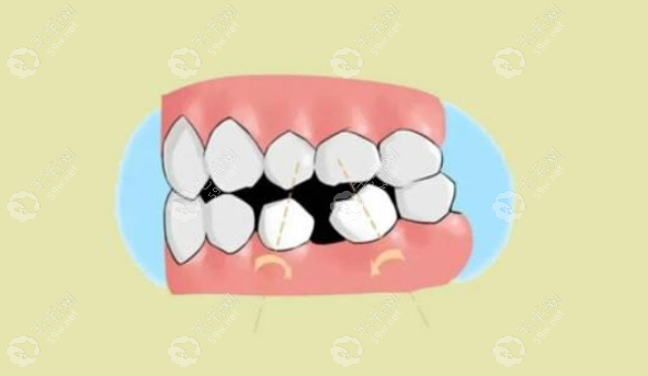 大牙拔除后不种牙会影响邻牙（倾斜和移动）