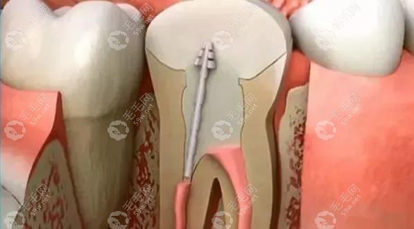 合肥牙齿根管治疗+补牙价格多少一颗