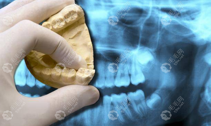 大牙拔除后不种牙会导致口腔功能受到限制