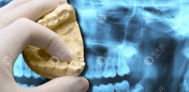 大牙拔除后不种植牙有影响吗?有!可能会危害邻牙和面部改变