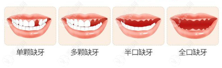 郑州唯美口腔种植牙价格查询www.59w.net