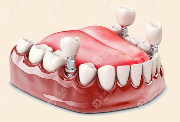 安种植牙多少钱一颗?2024安装种植牙的价格一般6000元起一颗