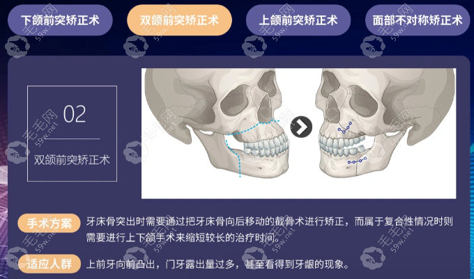 广州广大口腔正颌技术好价格不贵:找何锦泉-艾伟建正颌4万+