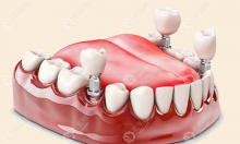 安种植牙多少钱一颗?2024安装种植牙的价格一般6000元起一颗