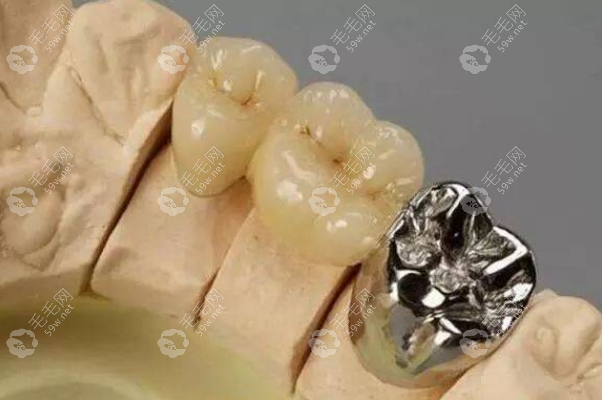 镶牙需要磨两边的牙吗?看情况,磨两边牙危害大吗看牙医技术