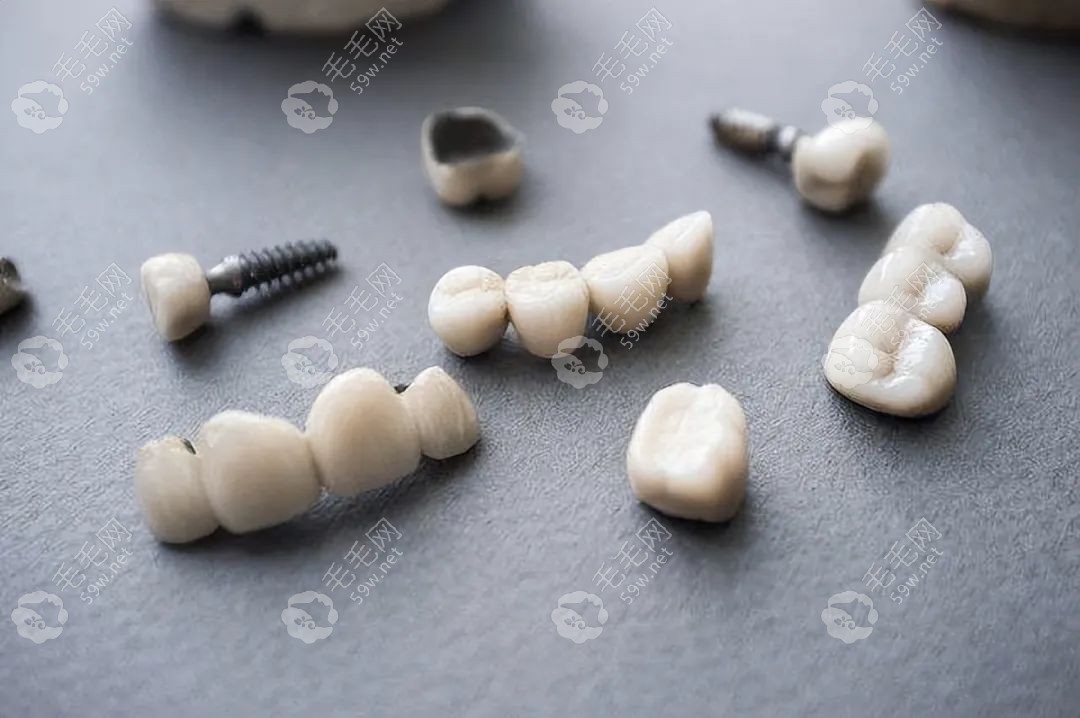 韩国纽百特种植牙质量好性价比高,材料是纯钛的,使用寿命长