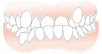 成人/儿童牙齿反颌矫正较佳年龄,牙反颌怎么矫正一文说清楚