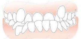 成人/儿童牙齿反颌矫正较佳年龄,牙反颌怎么矫正一文说清楚