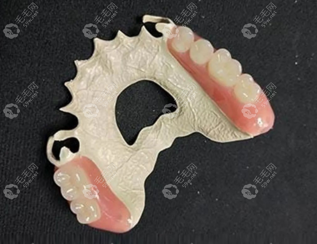 hpp假牙支架—般3000-4000元起,但一副hpp义齿支架能使用6年左右